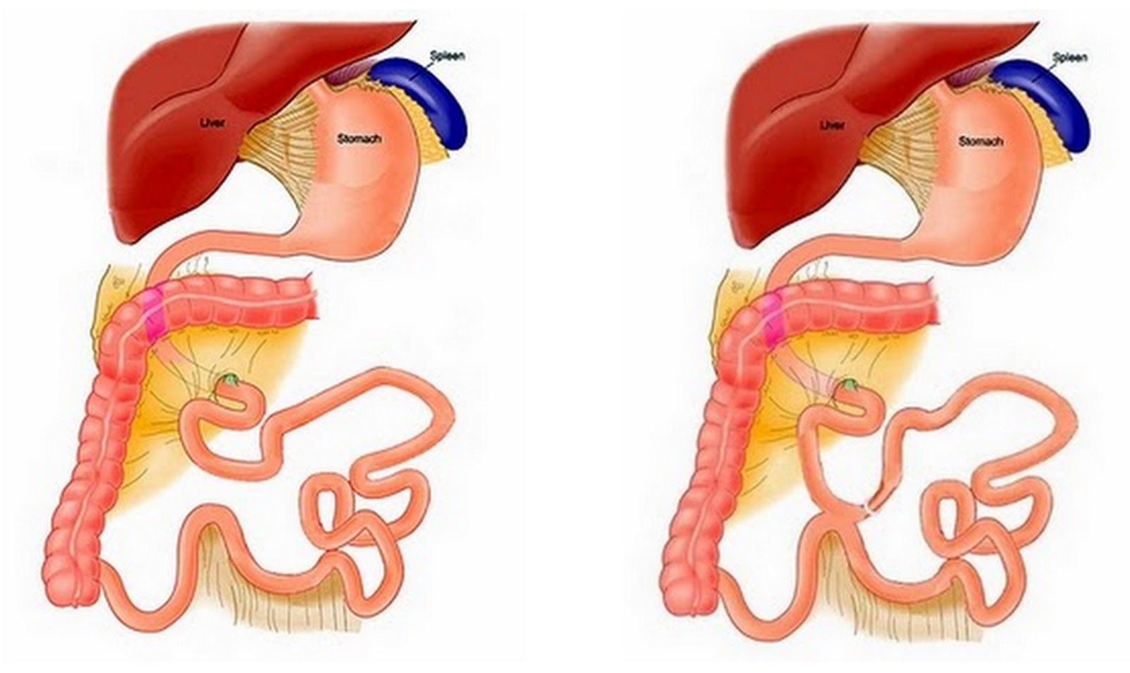 imagini bypass intestinal